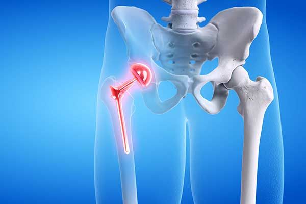 Hip Implant